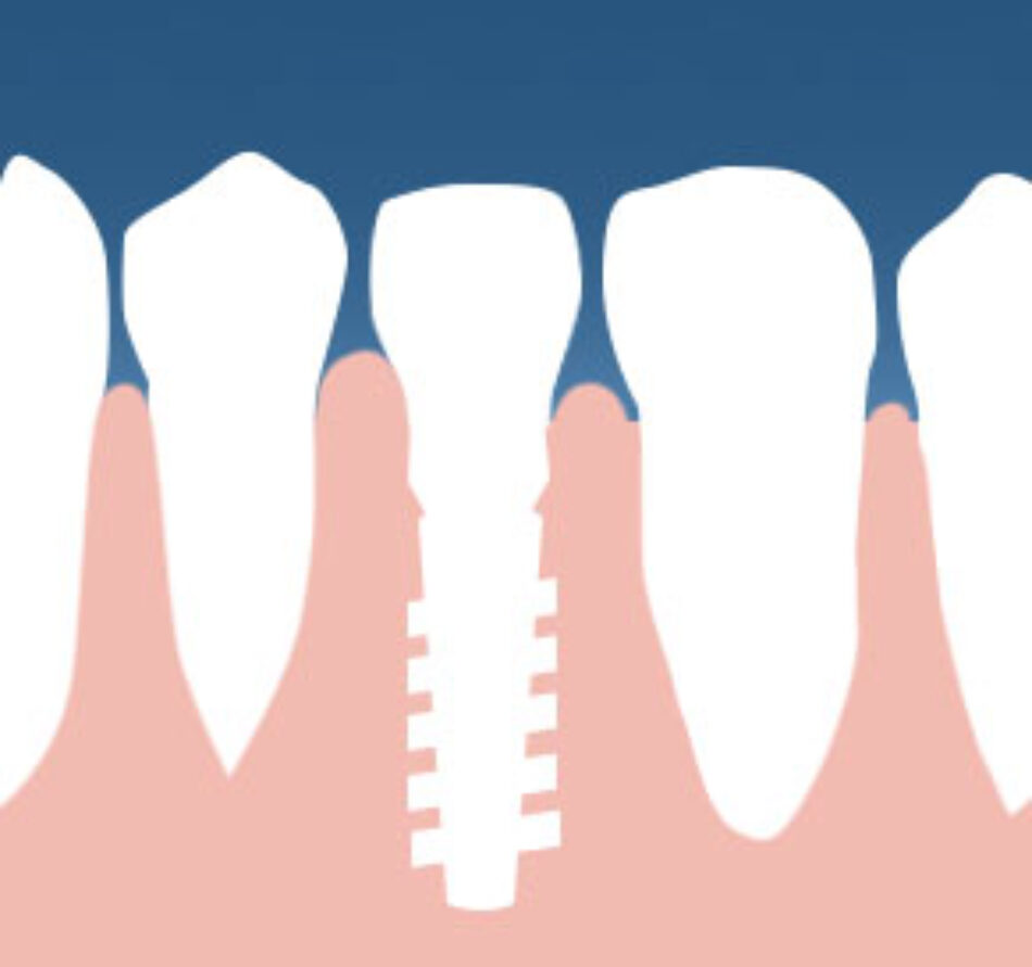 Implant Restoration - Danada Dental